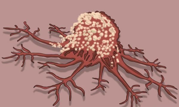 槟榔碱|口腔癌是怎么回事医生坦言一旦出现3个信号，尽快做检查