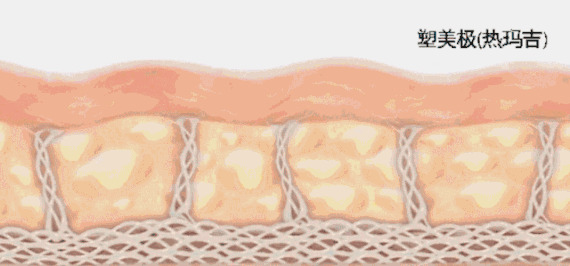 超声提升 热玛吉&超声提升,谁是抗衰NO.1?抗衰选它就对了!