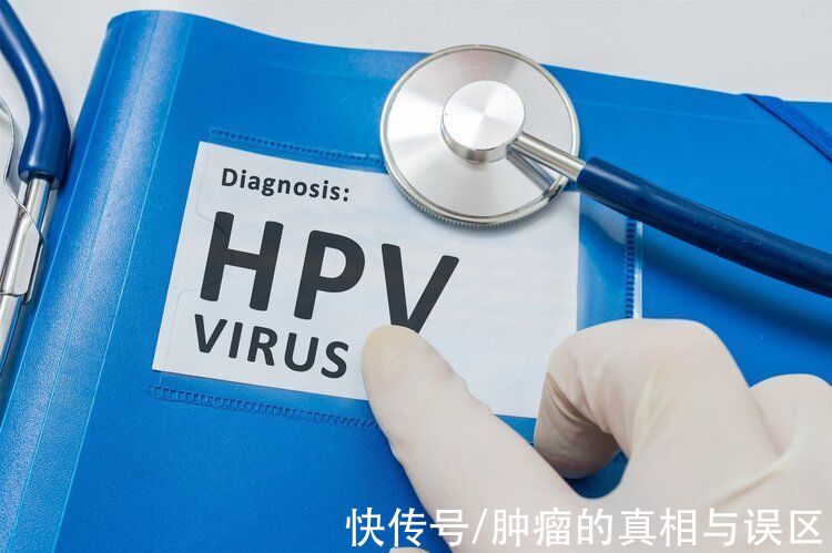 hpv|越来越多口咽癌由HPV感染导致，原因难以启齿，男女都应该了解