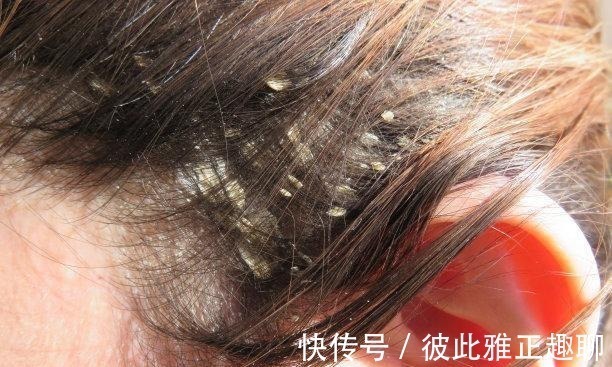 螨虫|浙江女性坚持用“硫磺皂水”洗头发,后来得到了啥?多数人想不到