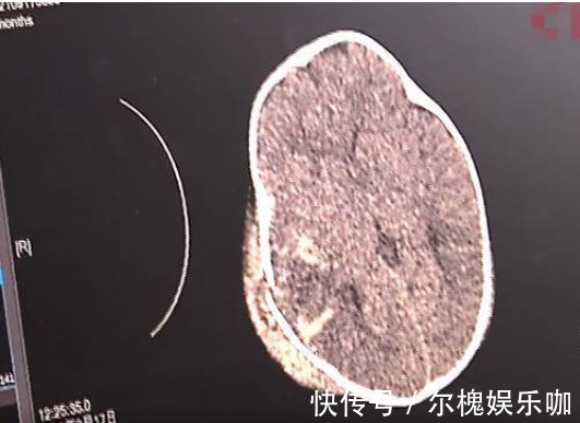 坠落|一把没抱住,7个月大的婴儿从13楼坠落!最终奇迹生还