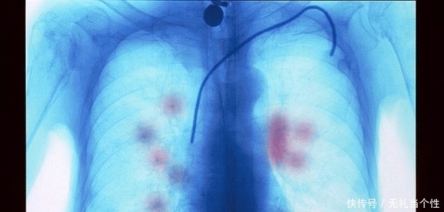 分期|假如你不幸患上“癌症”,你会怎么办是治疗还是放弃!