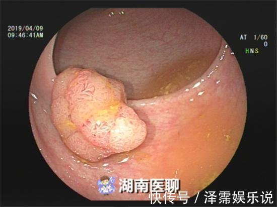隐血试验|男子便中带血以为是痔疮所致,结果却是癌!