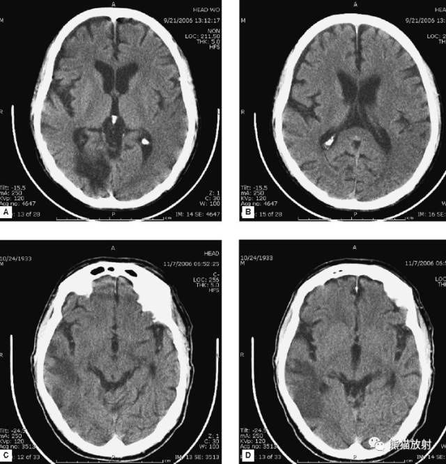 疾病|急诊颅脑CT不能漏的8种疾病