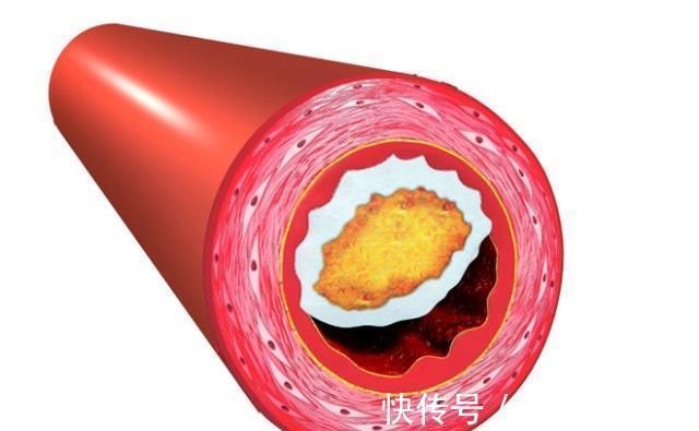 血管内膜损伤|中医提醒:不论男女,40岁之后,多吃3物,养护血管,预防血栓