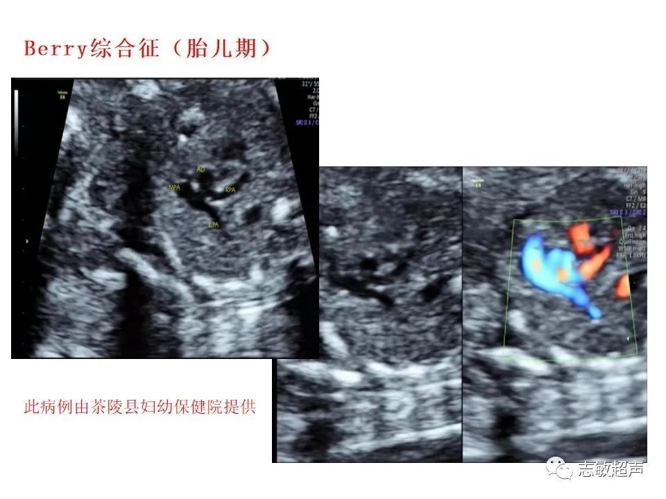 超声|肺动脉瓣周边异常血流的超声鉴别