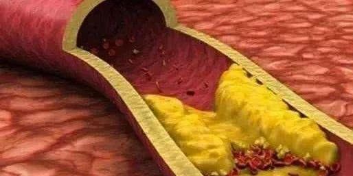 6种食物专克高血脂,每天换着吃,轻松降血脂,让血管更干净