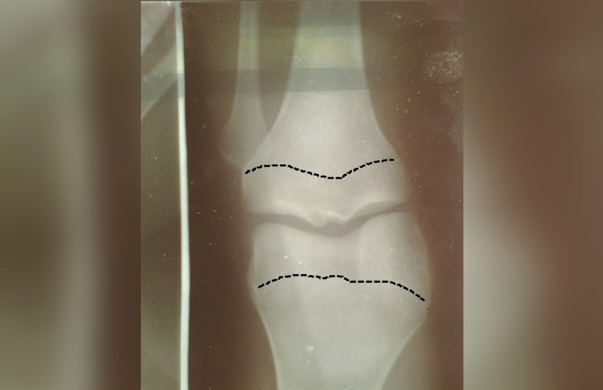 末班车|孩子身体的这三种信号,说明骨骼线即将闭合,父母一定要学会补救