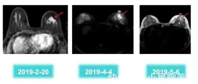放射治疗|同时被糖尿病和乳腺癌,折磨的女白领,含泪讲述哪个更威胁生命?