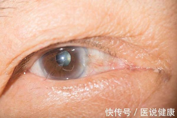 患者|视网膜病变，是糖尿病并发症之一，眼睛出现5种情况，需重视