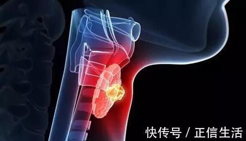 乳腺癌|钙化是癌变的信号和哪些癌症息息相关呢