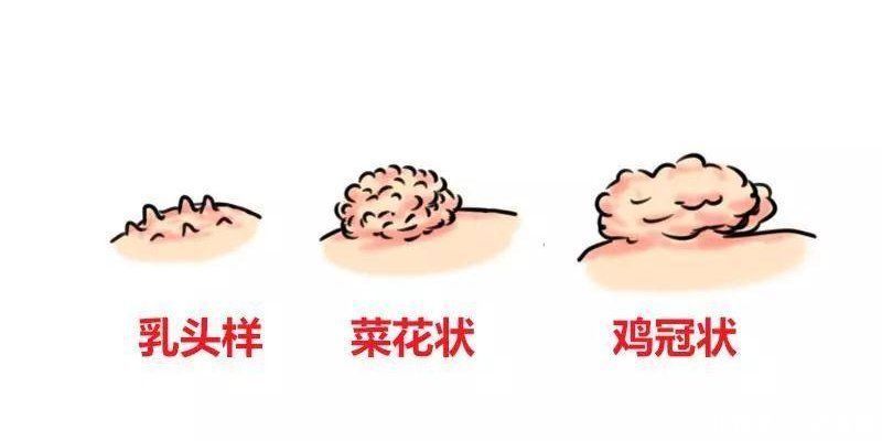 老伯|76岁老伯感染梅毒，过程公开：老伴去世多年，怎么可能是梅毒？