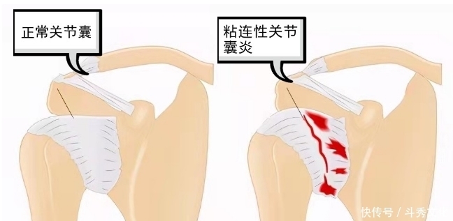 肩膀疼痛,并非肩周炎,问题在哪?您找对没?此文给您全新的认识