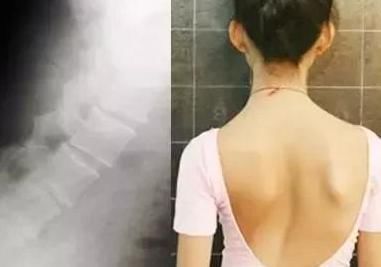 动作|12岁女孩弯腰时一个动作,被父母发现异常10个孩子就有2个中招