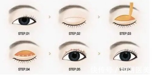 埋线双眼皮 割双眼皮需要多少钱?原来手术方式不一样价格也不同!快来看看你割双眼皮需要多少钱?