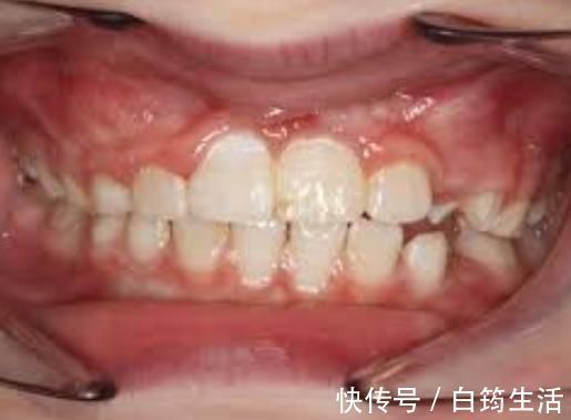 牙齿|孩子换牙齿，新长的牙齿却是歪的，可能是家长这些没做好