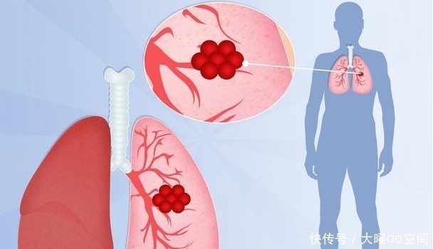 肺癌|肩膀这样疼痛时,是肺在向你发出“求救”信号,不能轻易忽视