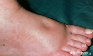 动脉粥样硬化|专家提醒这1物是天然“溶栓王”,一日三杯,血管不堵、不硬