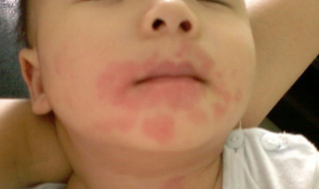 家长|为什么最好别给宝宝吃“鸡蛋羹”儿科医生劝诫数次,家长仍乱来