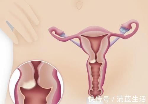 肌瘤|子宫肌瘤不可怕,学会这几招帮你调理,肌瘤可能会慢慢“消失”