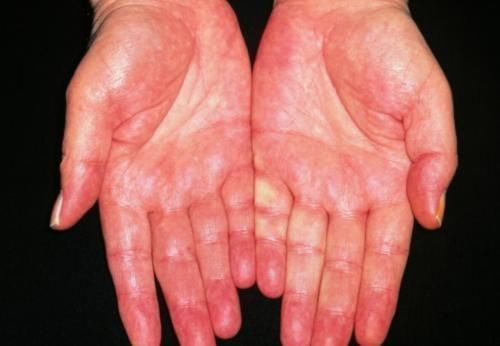 现象|肝不好的人,手上会有此4个现象,你若没有,说明你肝很好