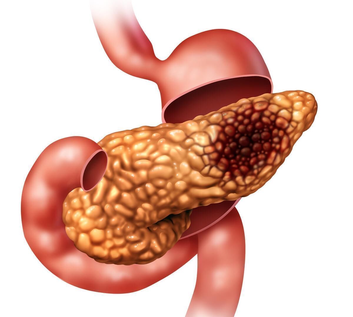 恶性|得了癌症一般多久后就会慢慢瘦医生这些是影响因素