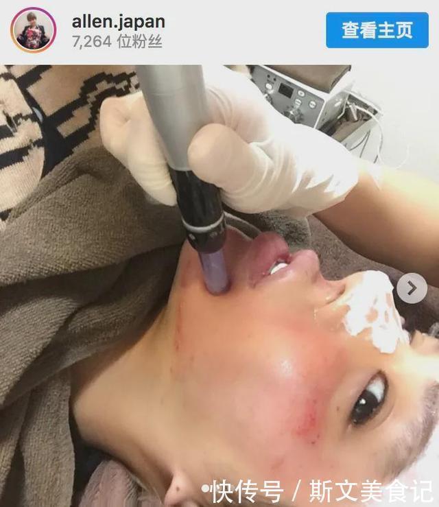 艾伦|日本一帅气小伙花1亿做全身整容，最后终于整成了“悲伤蛙”