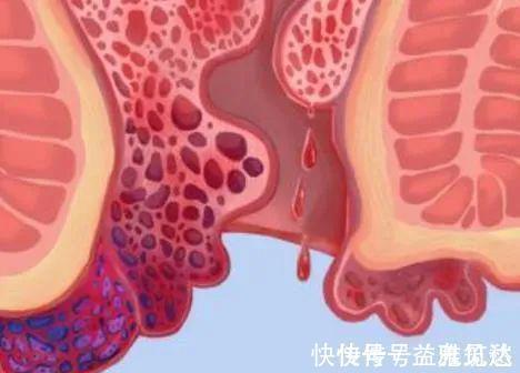 绝招|屁股便血长肉球千万别忽视,肛肠科大夫教你这三个绝招!