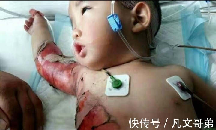 水壶|三岁小女孩碰中开水壶,重度烫伤,妈妈喊到:没别忙活了,让她走