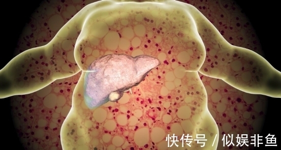 蔬菜|90岁院士提醒:肝不好,少吃2种蔬菜,小心转氨酶过高