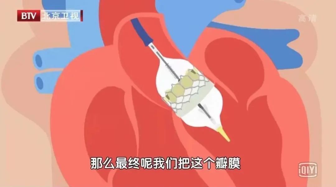 瓣膜|高血压“突然正常”,别急着高兴!很有可能是这种致命危机