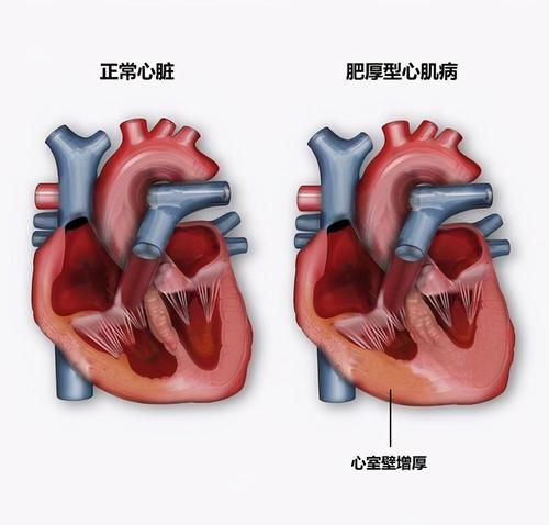 什么叫做限制性心肌病？患病原因是多样性的，要及时采取治疗方法