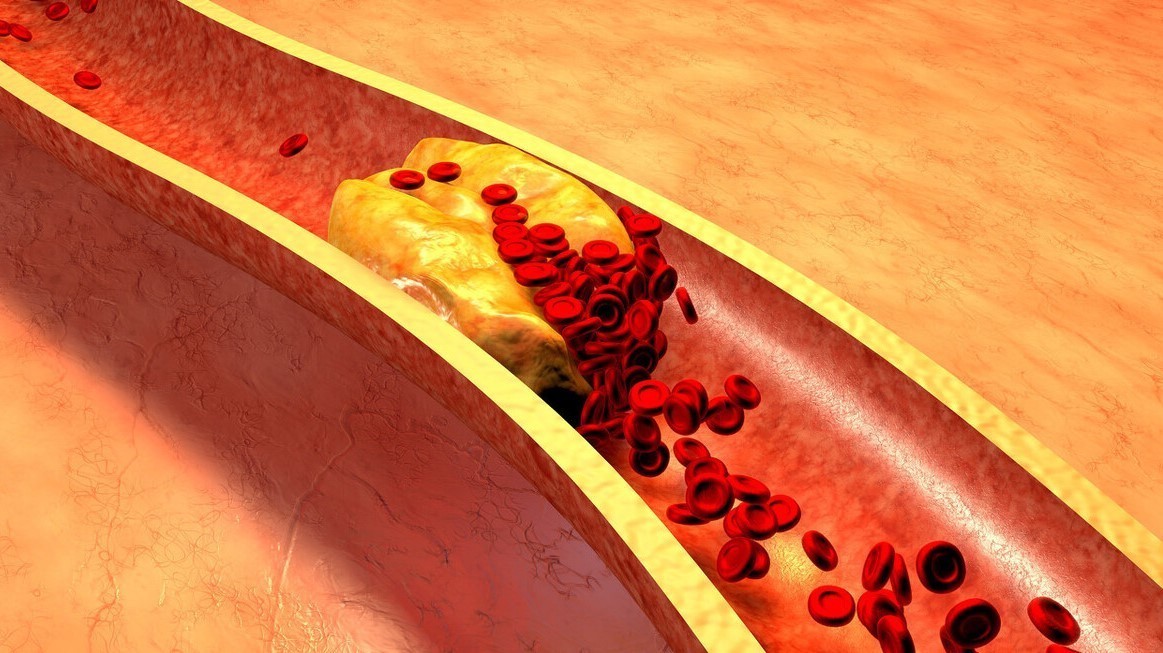 猪油|吃荞麦能够降血脂心内科医生提醒2种“升脂大户”要少碰