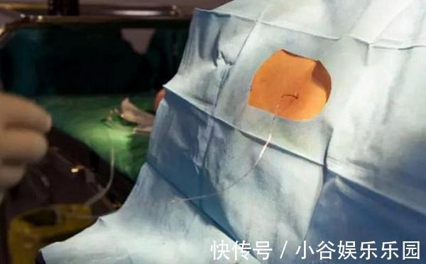 半麻|剖腹产的半麻和全麻,到底有什么区别?后者关系到胎儿健康