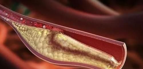 高血脂|高血脂“祸根”找到了，医生提醒：3件事再做，小心甘油三酯爆表