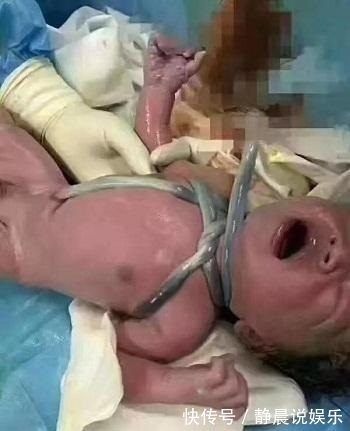 剖腹产|因孕妈做错一件事,孕38周紧急剖腹产,宝宝“五花大绑”出生