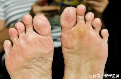 心率|寿命长的人,脚上往往会有2个共性,若你也有,长寿体质就是你!