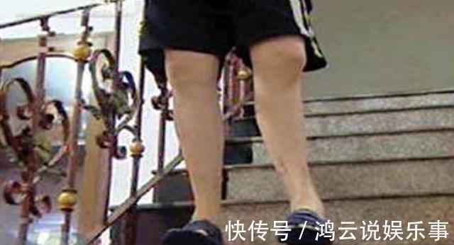 增高|还记得那个花16万、断骨增高7.2厘米的李亚诺吗?后来身体怎样?