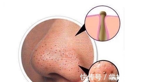 焕肤|鼻子上黑头多怎么办,这样做让你告别“草莓鼻”