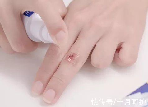 残疾|三岁女童被活活截断手指,终生残疾!只因用错创可贴,快自查