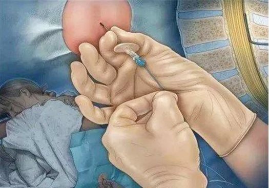 全过程|剖腹产不就是“划肚取胎”组图揭秘全过程,看完才懂母亲的伟大