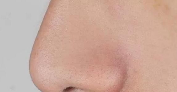 脂溢性皮炎|鼻翼两侧挤出白色分泌物是啥?别再用手挤了,当心越来越多