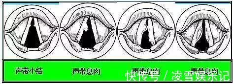 胃息肉|长大后,它就成了癌!到底要多久?看完这篇,了解息肉的全部