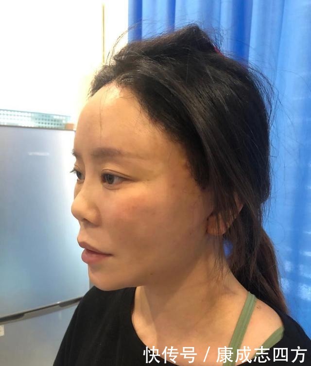 求美者|小拉皮术后1个月,总结几点我的体验感受