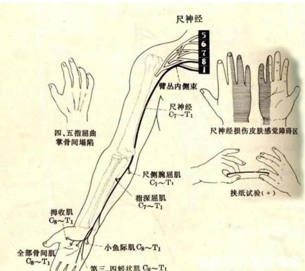 颈椎间盘|这几种病都能引起手麻,容易和颈椎病混淆,究竟如何区分好?