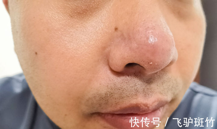 毛孔|去油从清理毛孔脏东西开始——DOCO小气泡黑头仪体验