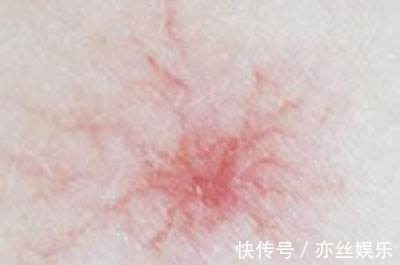 皮肤过敏|身体2处“发痒”,别误以为是过敏了,或是肝脏癌变发出的求救信