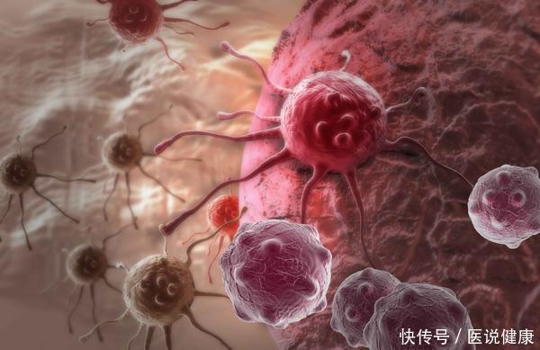 腺瘤性息肉|什么叫“癌前病变”这四类常见的癌前病变，现在了解还不算晚