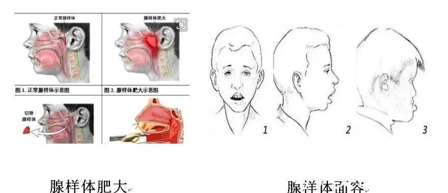 睡眠呼吸暂停|别让漂亮的孩子变成“丑小鸭”——腺样体肥大影响孩子的容貌