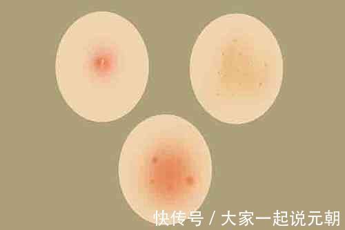 规则性|皮肤下面长出大包,是癌症信号?医生哭笑不得:满足3点才有可能